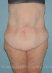 before front view surgery after major weight loss of female patient 2970