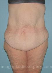 before front view surgery after major weight loss of female patient 2970