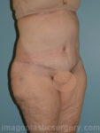 after right angle view surgery after major weight loss of female patient 2970