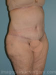 after right angle view surgery after major weight loss of female patient 2970