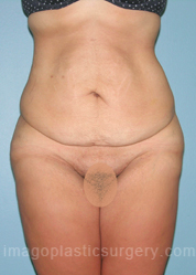 before front view surgery after major weight loss of female patient 2975