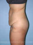 before left side view surgery after major weight loss of female patient 2975