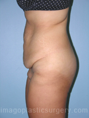 before left side view surgery after major weight loss of female patient 2975