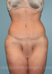 after front view surgery after major weight loss of female patient 2975