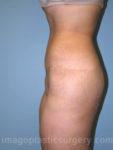 after left side view surgery after major weight loss of female patient 2975