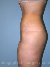 after left side view surgery after major weight loss of female patient 2975