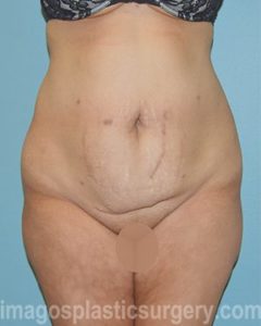 before front view surgery after major weight loss of female patient 2982