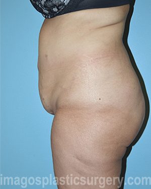 before left side view surgery after major weight loss of female patient 2982