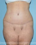 after front view surgery after major weight loss of female patient 2982