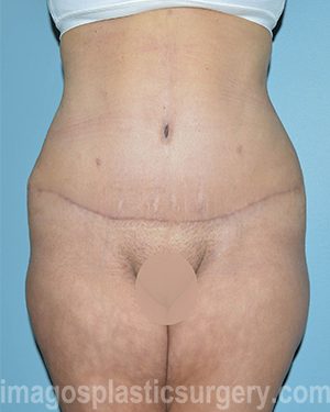 after front view surgery after major weight loss of female patient 2982