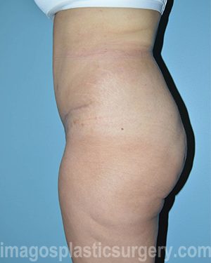 after left side view surgery after major weight loss of female patient 2982