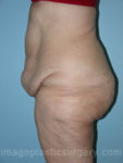 before left side view surgery after major weight loss of female patient 2991
