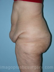 before left side view surgery after major weight loss of female patient 2991