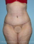 after front view surgery after major weight loss of female patient 2991