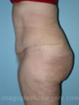 after left side view surgery after major weight loss of female patient 2991