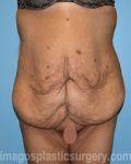 before front view surgery after major weight loss of female patient 2999