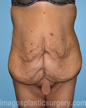 before front view surgery after major weight loss of female patient 2999