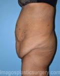 before left side view surgery after major weight loss of female patient 2999