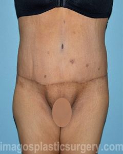 after front view surgery after major weight loss of female patient 2999