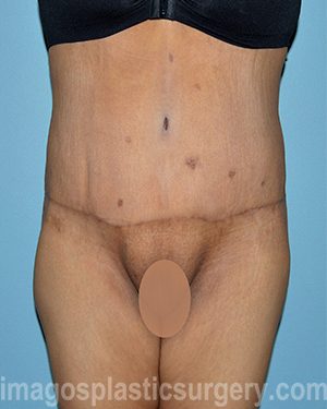 after front view surgery after major weight loss of female patient 2999