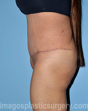 after left side view surgery after major weight loss of female patient 2999