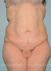 before front view surgery after major weight loss of female patient 3004