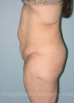 before left side view surgery after major weight loss of female patient 3004