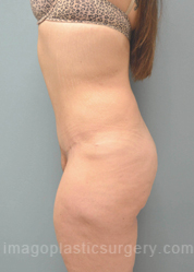 after left side view surgery after major weight loss of female patient 3004