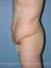 before left side view surgery after major weight loss of female patient 3012