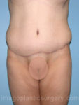 after front view surgery after major weight loss of female patient 3012