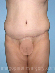 after front view surgery after major weight loss of female patient 3012