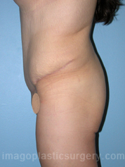 after left side view surgery after major weight loss of female patient 3012