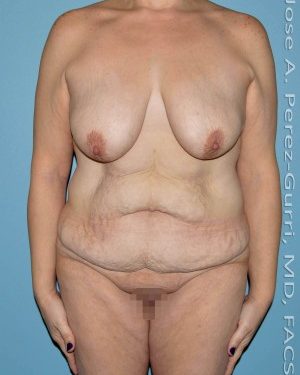before front view surgery after major weight loss of female patient 3018