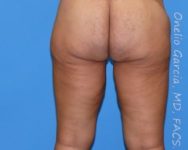 after back view thigh lift of female patient 2954