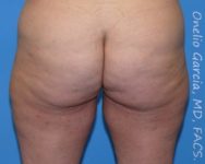 before back view thigh lift of female patient 2959