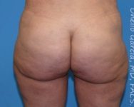 after back view thigh lift of female patient 2959