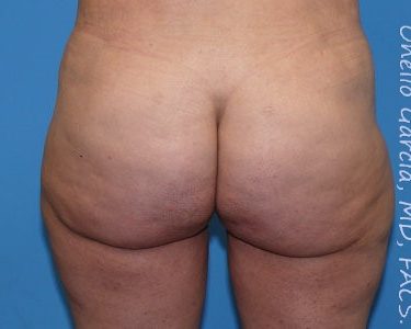 after back view thigh lift of female patient 2959