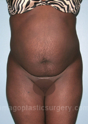 before front view tummy tuck of female patient 2848
