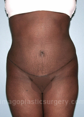 after front view tummy tuck of female patient 2848