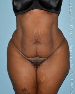 before front view tummy tuck of female patient 2855