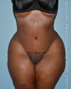 after front view tummy tuck of female patient 2855