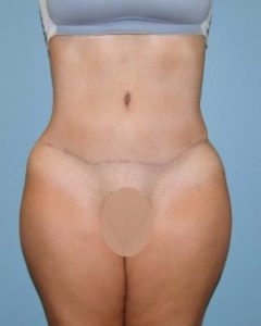 after front view tummy tuck of female patient 2861