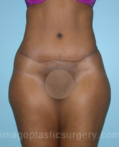after front view tummy tuck of female patient 2866