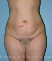 before front view tummy tuck of female patient 2871