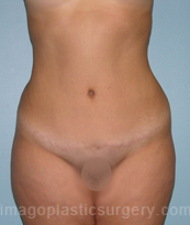 after front view tummy tuck of female patient 2871