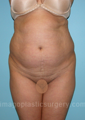 before front view tummy tuck of female patient 2882