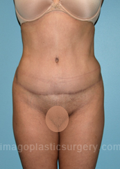 after front view tummy tuck of female patient 2882