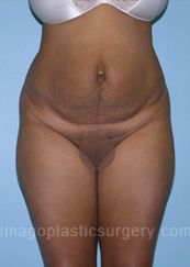 before front view tummy tuck of female patient 2887