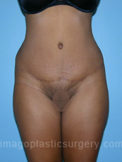 after front view tummy tuck of female patient 2887