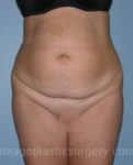 before front view tummy tuck of female patient 2892